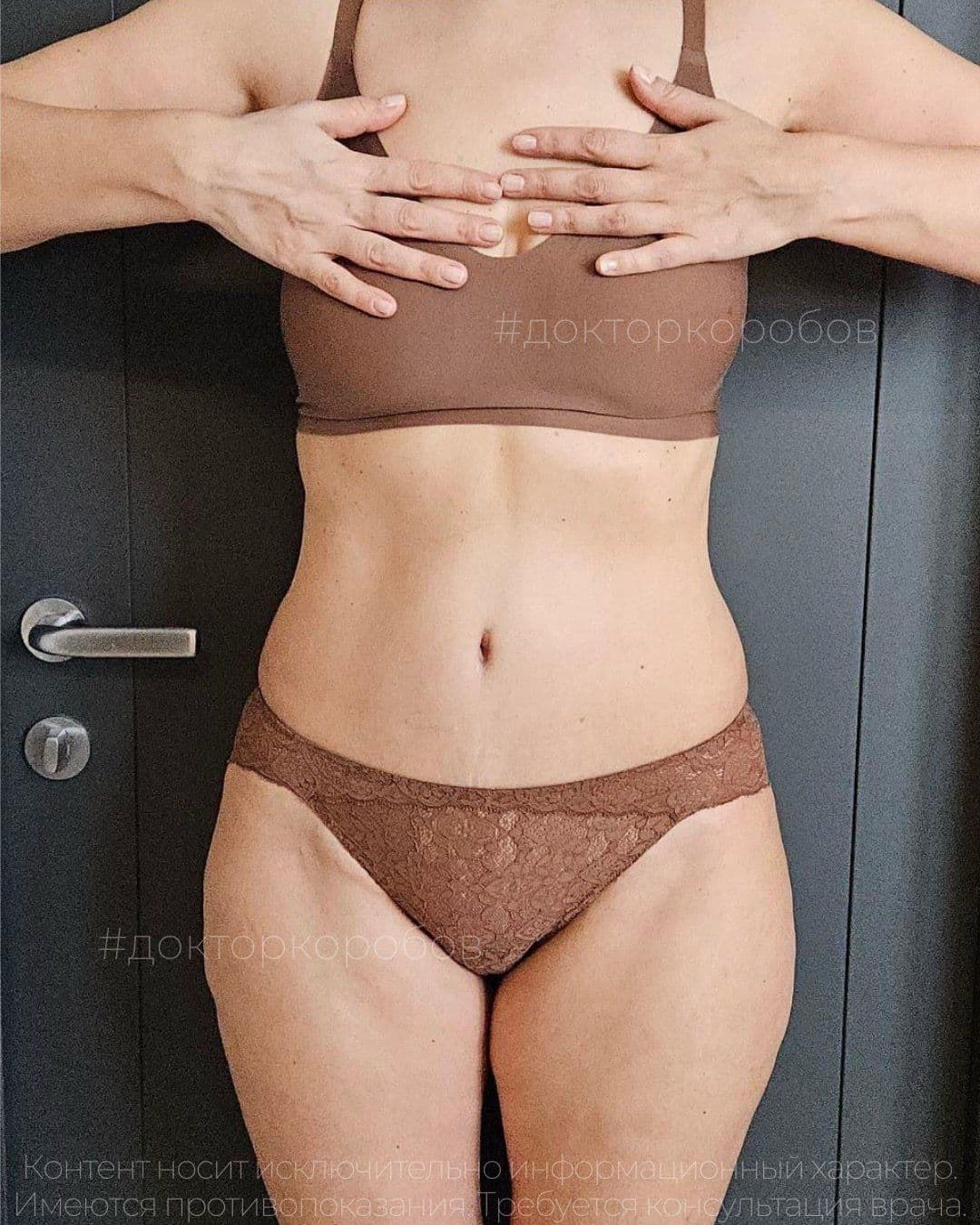 Клинический случай «abdominoplastika-diastaz-3-mesyaca», материал 8